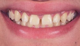 Cas clinique apres Global Esthetics Laboratoire Protheses Dentaires (2)