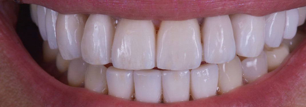 Cas clinique apres Global Esthetics Laboratoire Protheses Dentaires Bordeaux