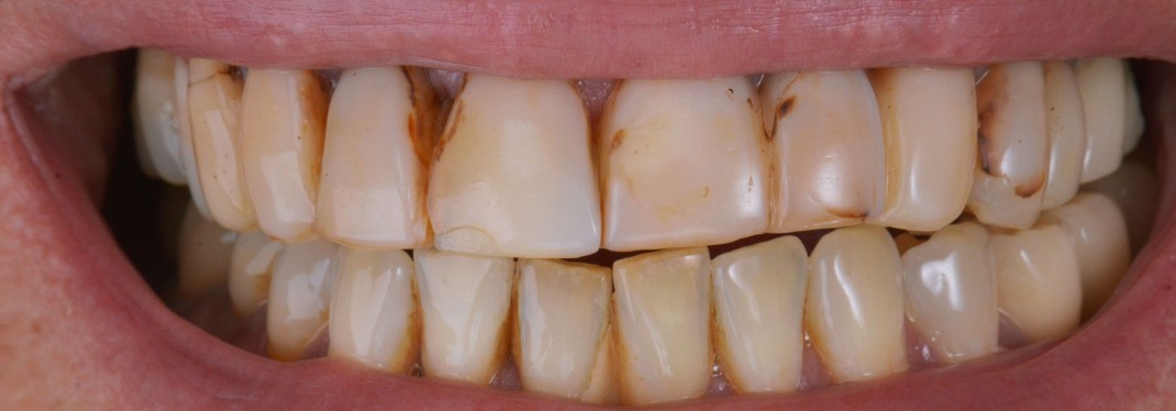 Cas clinique avant Global Esthetics Laboratoire Protheses Dentaires Bordeaux