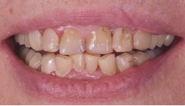 Cas clinique avant Global Esthetics Laboratoire Protheses Dentaires